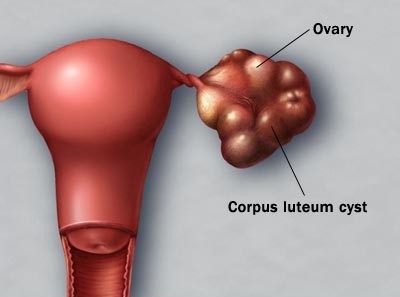 cyst ovari