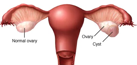 cyst ovari