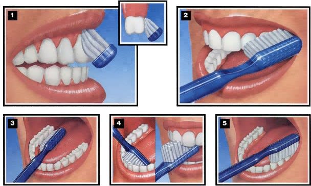 cara putihkan gigi