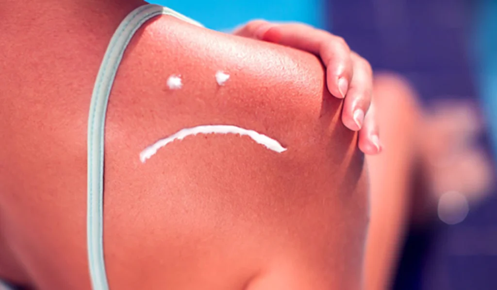 cara hilangkan sunburn