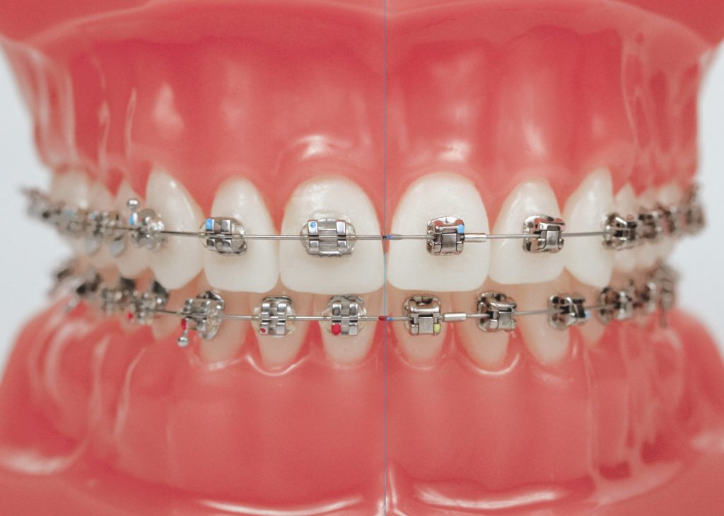  jenis gigi yang boleh pakai braces