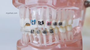 jenis gigi yang boleh pakai braces